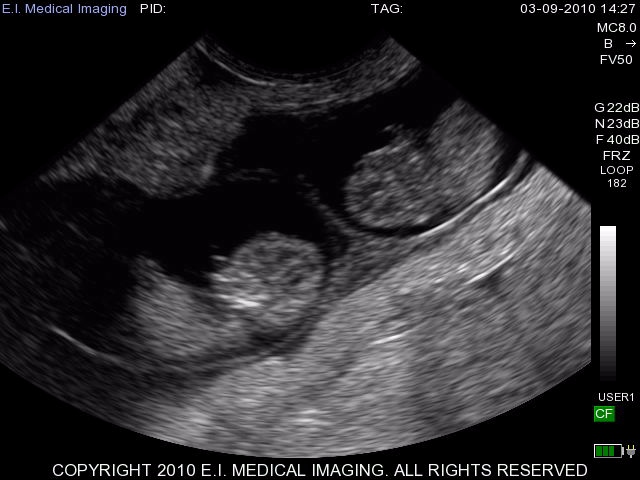 45 day twins bovine w 6 10MHz Micro Convex