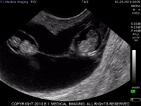 ibex ultrasound
