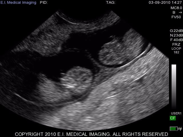 45 day twins bovine w 6 10MHz Micro Convex