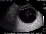 Ibex ultrasound