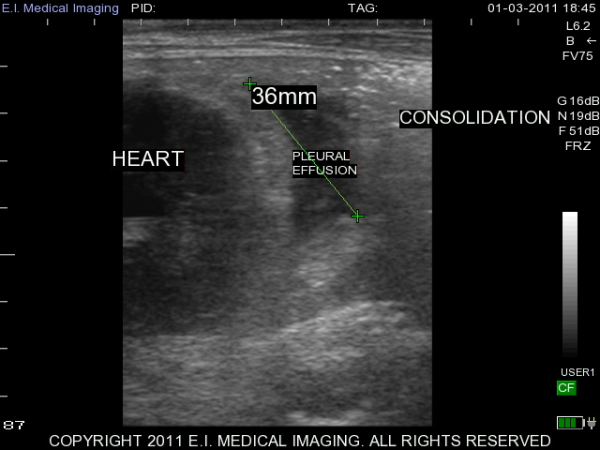 Ultrasound image calf pleural effusion