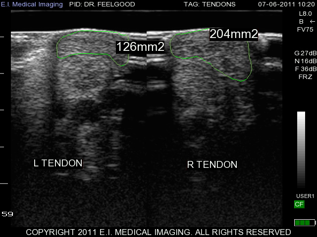 tendon xc comparison
