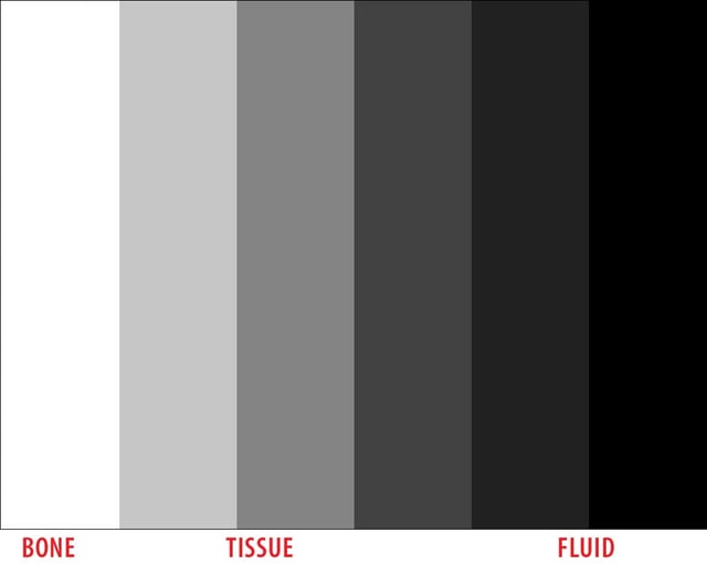 ultrasound gray scale