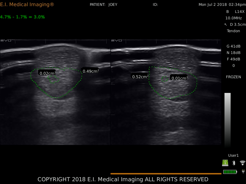 Tendon lesion comparison