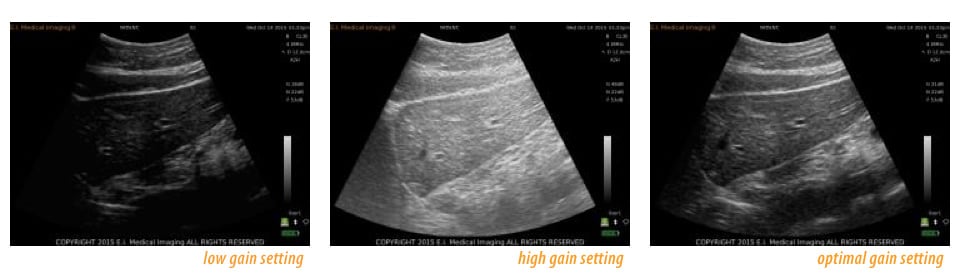 Understanding Gain in Ultrasound Understanding Gain in Ultrasound